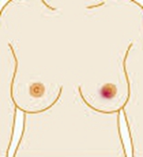 女性的乳腺癌早期症状表现的图片