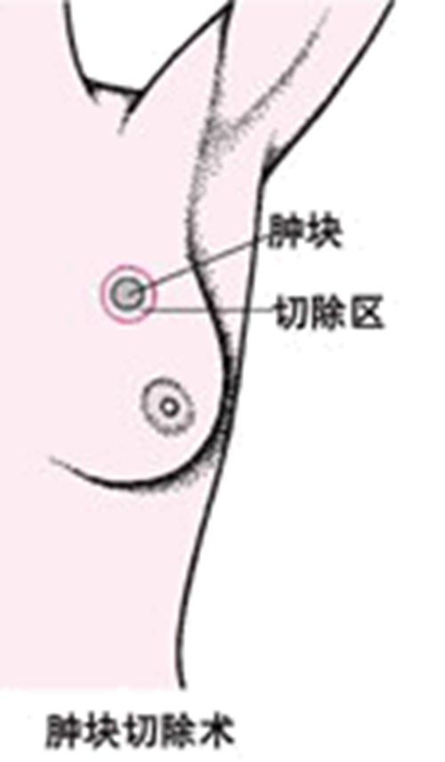 女性乳腺癌的早期症状图片