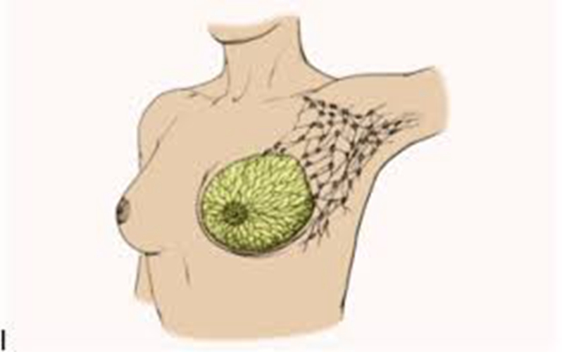 女性乳腺癌早期症状的原理图片