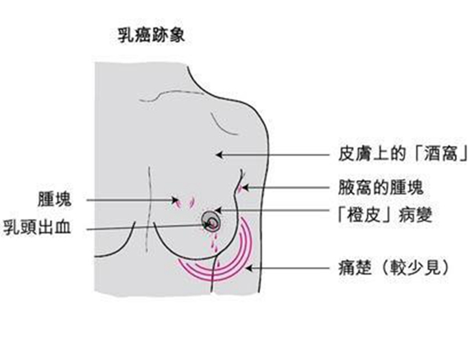 乳腺癌的早期的具体的症状图片