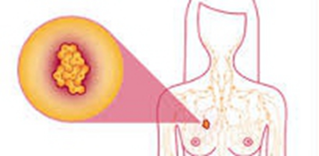 乳腺癌早期的症状表现图片