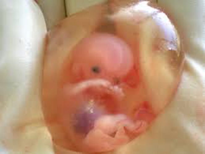 早孕药流排出的孕囊形状图片