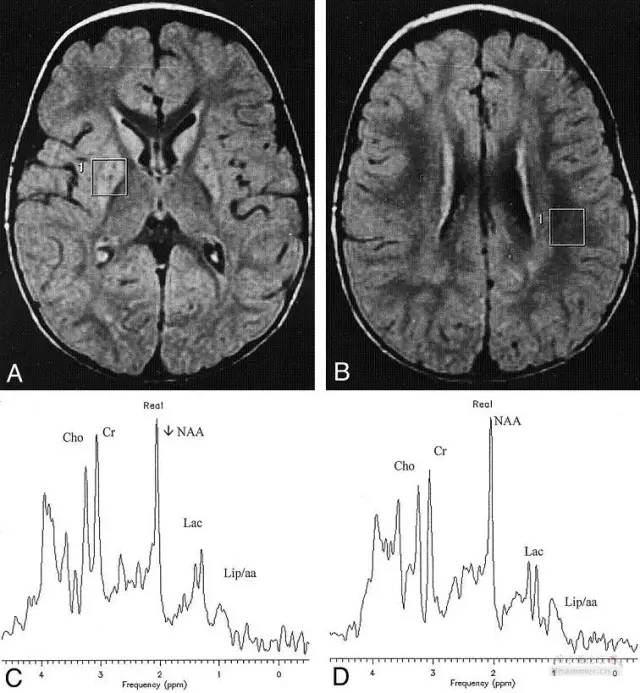 亚急性坏死性淋巴结炎治疗方法