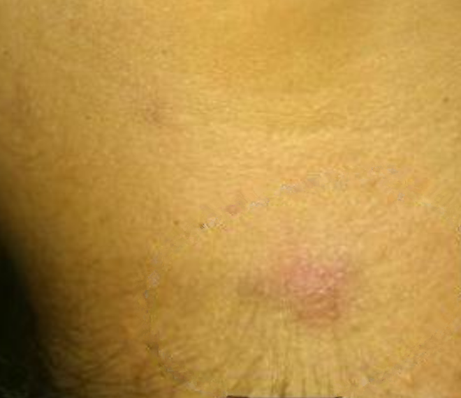 女性的腋下淋巴癌早期症状的图片