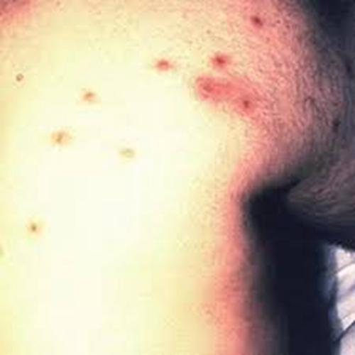 艾滋病初期背部皮肤红点图片