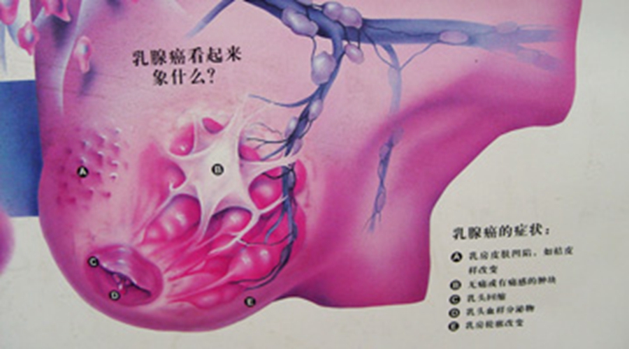 女性乳腺癌早期症状原理的图片