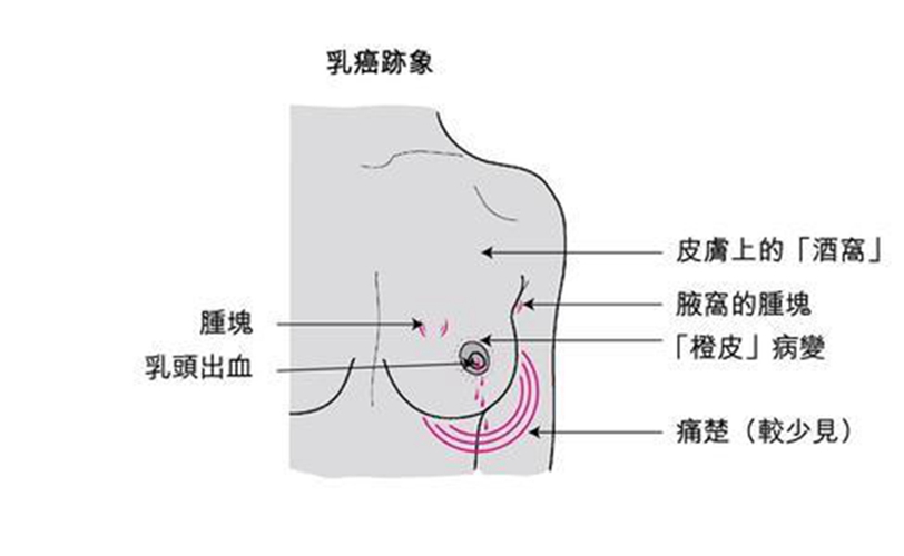 女性乳腺癌早期症状表现的图片