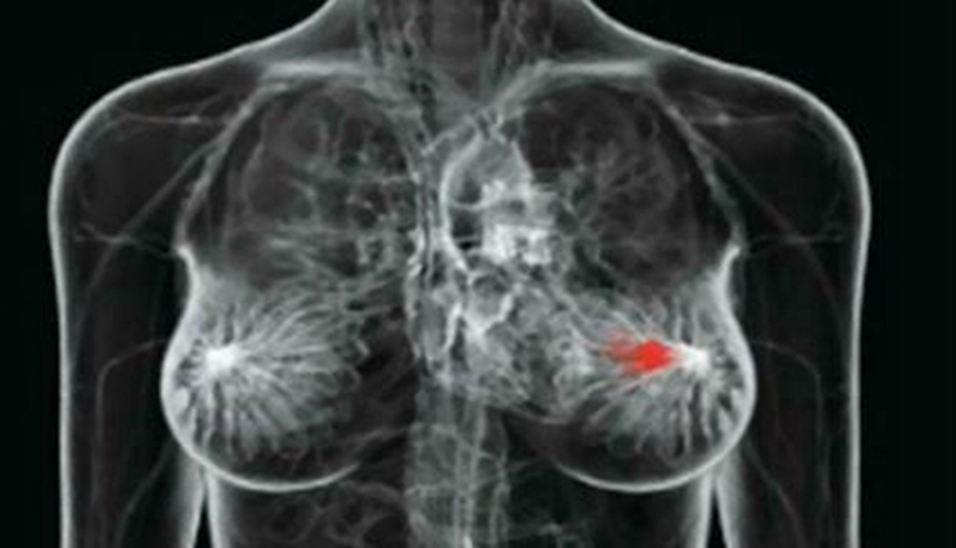 乳腺癌的早期具体症状图片
