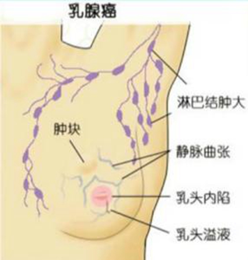 乳腺癌早期的具体症状的图片