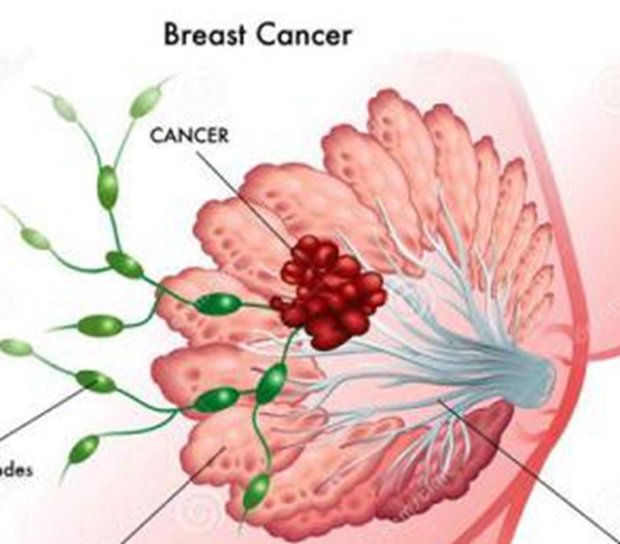乳腺癌早期具体症状图片