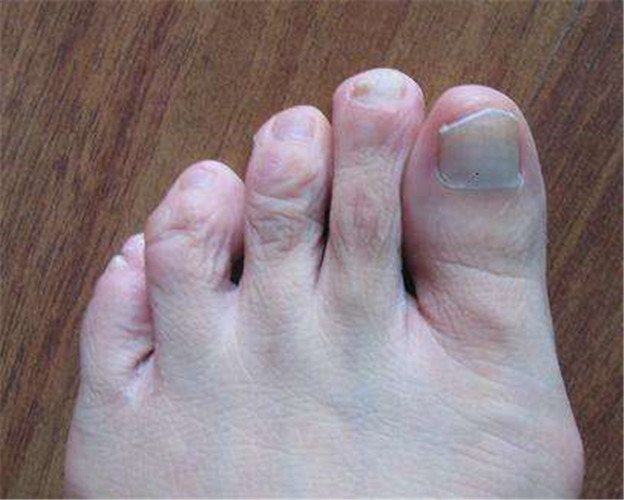 灰指甲初期图片脚趾头