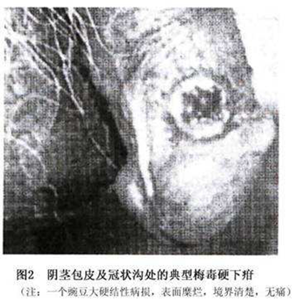 梅毒阴囊皮表面图片图片