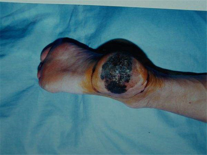 恶性黑色素瘤早期症状图片