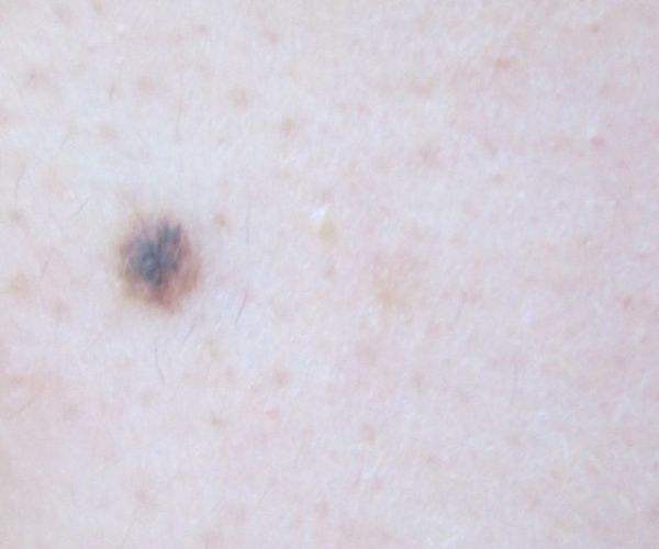 黑色素瘤典型早期图片