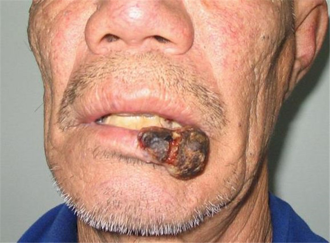 唇癌早期图片