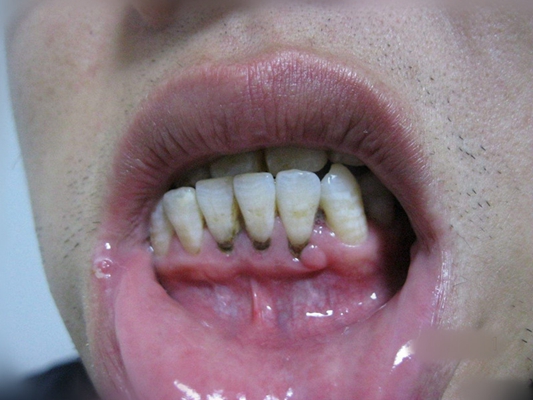 牙龈瘤 (10)