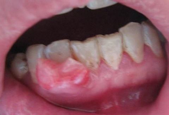 牙龈瘤 (13)