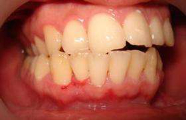牙龈瘤 (45)