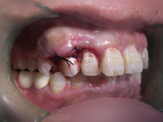 牙龈瘤 (42)