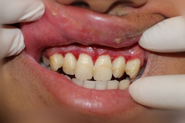 牙龈瘤 (48)