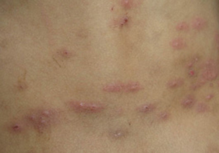 结节性痒疹 (28)