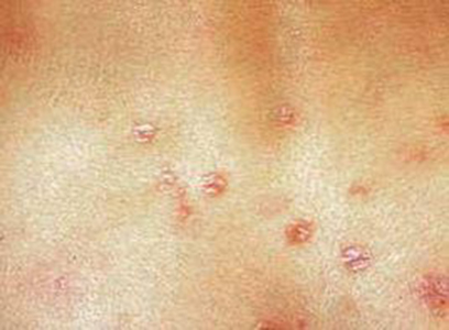 结节性痒疹 (36)