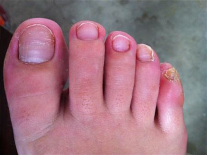 灰指甲初期症状图片