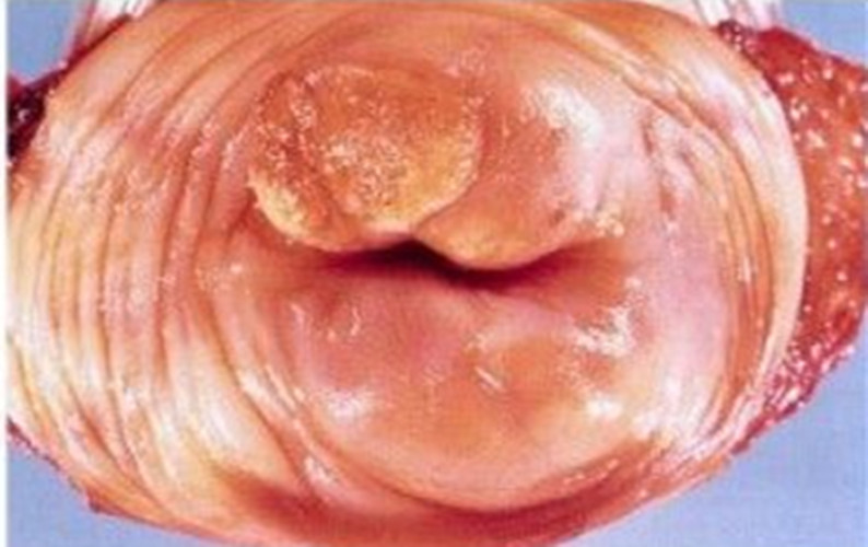 宫颈病变的早期症状图片