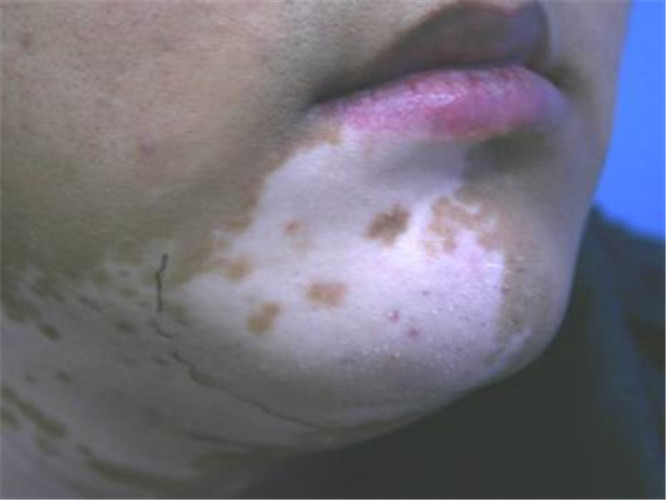 白色念珠菌感染症状图