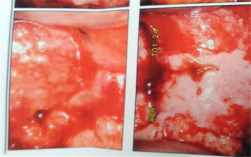 宫颈手术脱痂出血图片图片