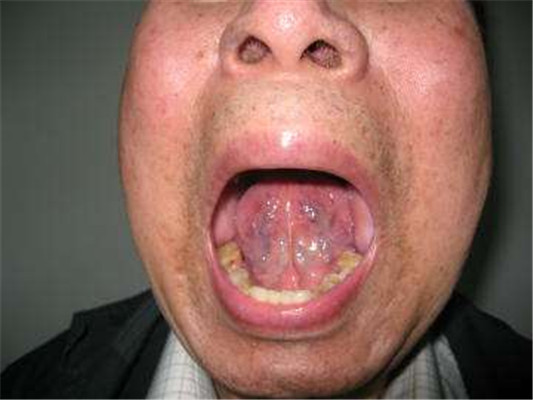 严重慢性咽炎舌头图片图片