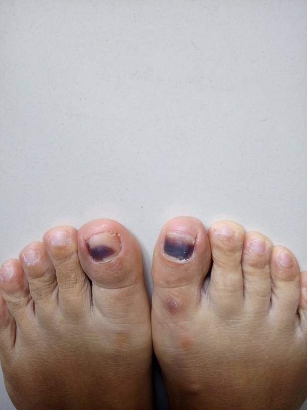 脚指甲黑色素瘤图片图片