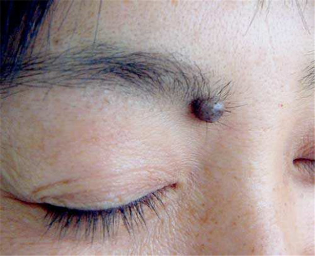 眉间良性黑色素瘤图片