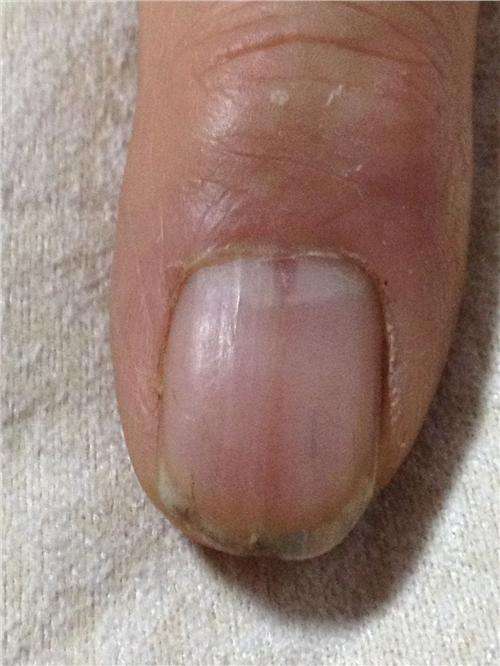 指甲良性黑素瘤图片