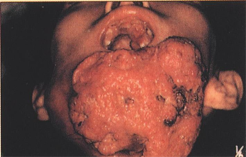 唇癌晚期图片图片