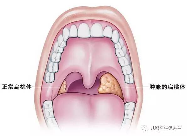 怎样预防扁桃体发炎