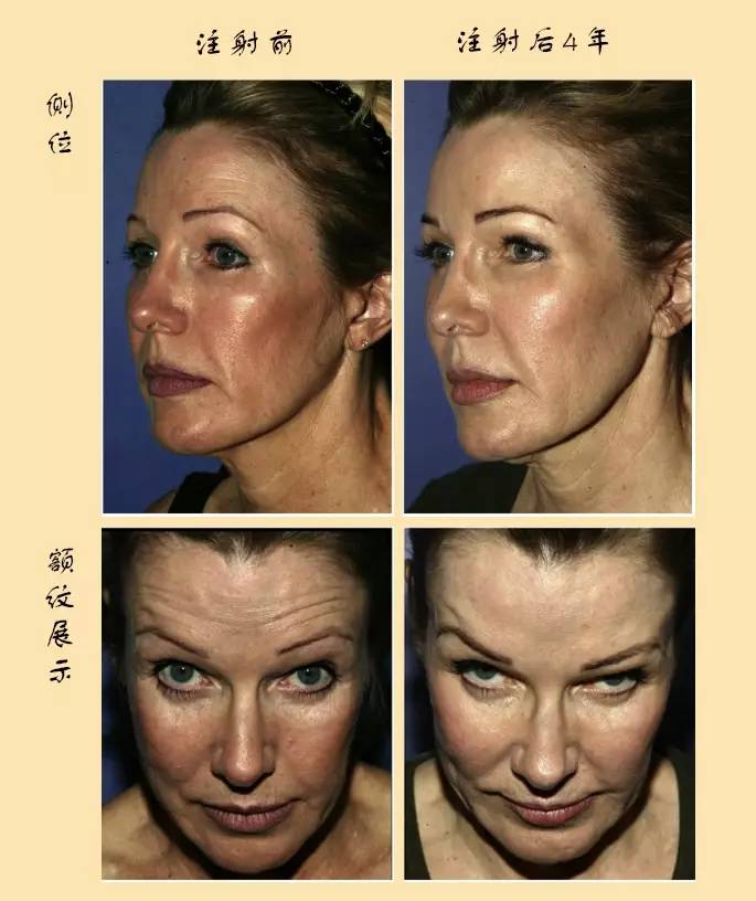 抵抗面部衰老,你以为光拉皮就够了吗?