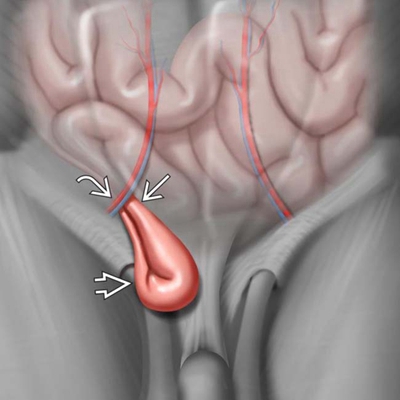 睾丸疝气图片 (2)