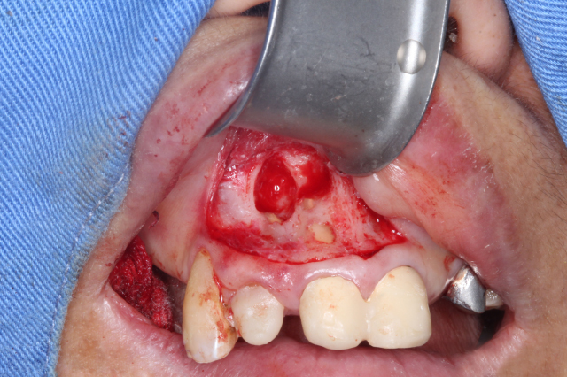 牙根尖脓肿严重的图片图片