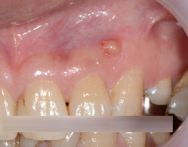 牙根尖周炎瘘管图片图片