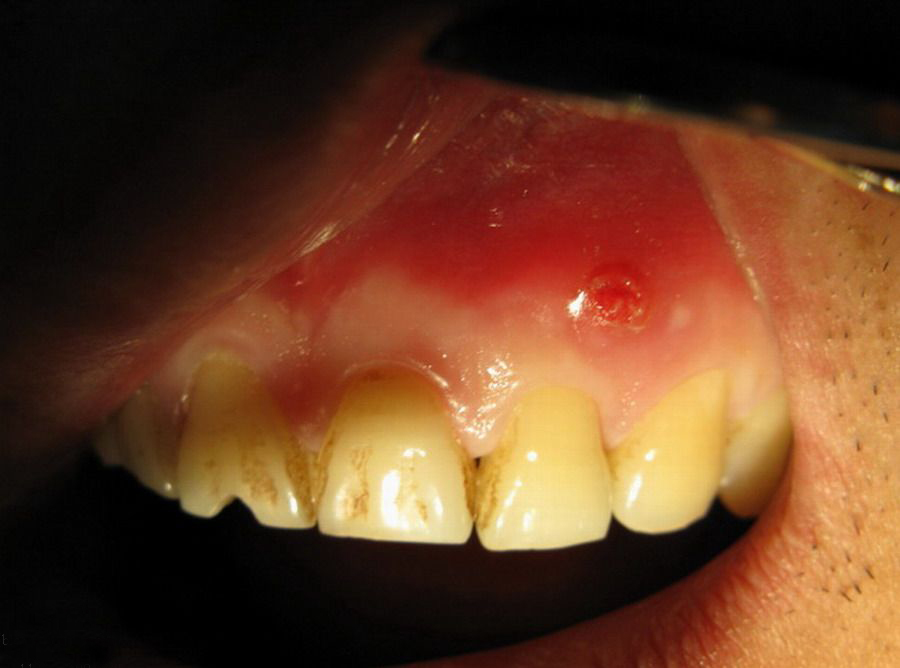 慢性牙根尖炎症状图片图片