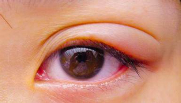 眼睑皮炎的症状图片图片