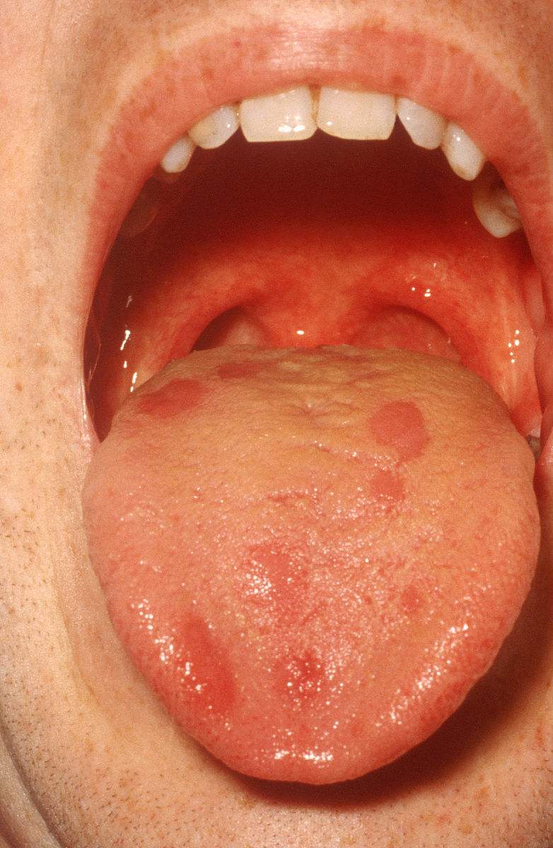 癌症早期舌象图片图片