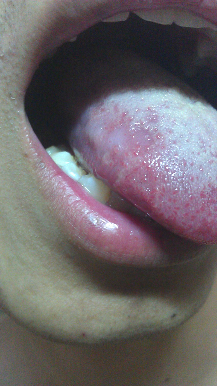 颗粒型舌白斑图片