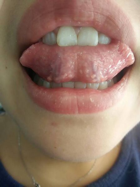 舌头尖锐湿症状图片图片