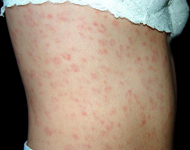 梅花疹的症状图片