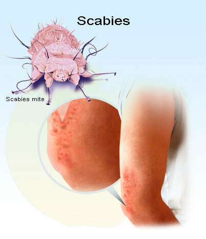 疥虫感染睾丸的图片图片