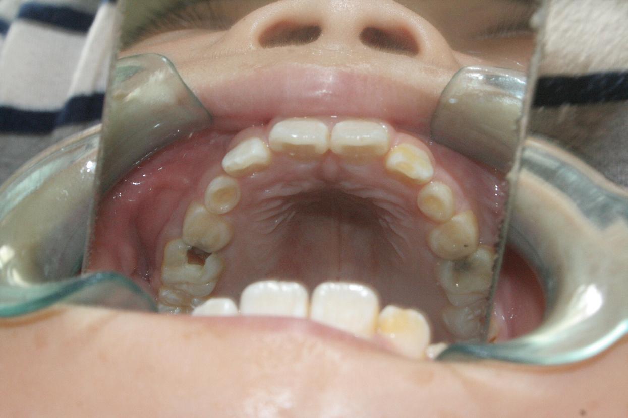 宝宝蛀牙早期症状图片,蛀牙初期图片 - 伤感说说吧