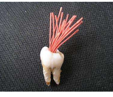 牙齿根管治疗 (4)