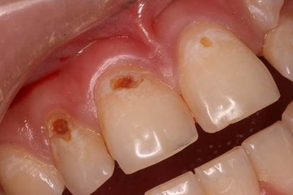牙齿根管治疗 (48)
